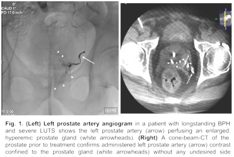 Prostate Artery Embolization Radiologic Imaging Consultants 7253